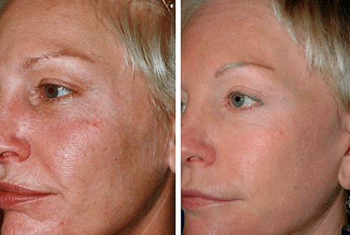 prieš ir po frakcinio odos atjauninimo 1 nuotrauka