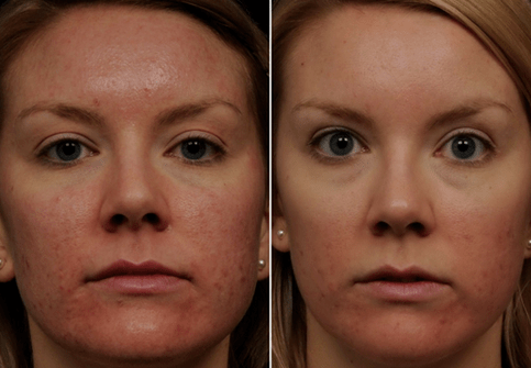 prieš ir po frakcinio odos atjauninimo 6 nuotrauka