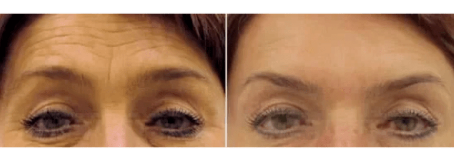 Prietaisai daliniam atjauninimui