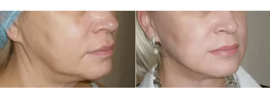 atsigavimas po odos atjauninimo